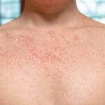 Sarampión puede llegar de fuera