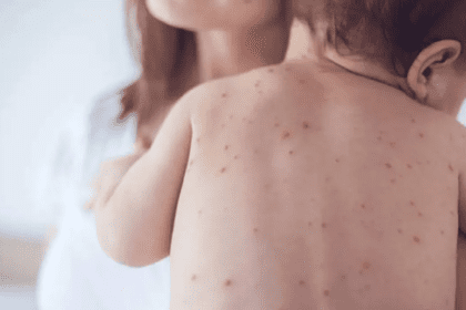 alerta sarampion jlb