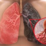 Cáncer de pulmón va en aumento, se presenta también en jóvenes