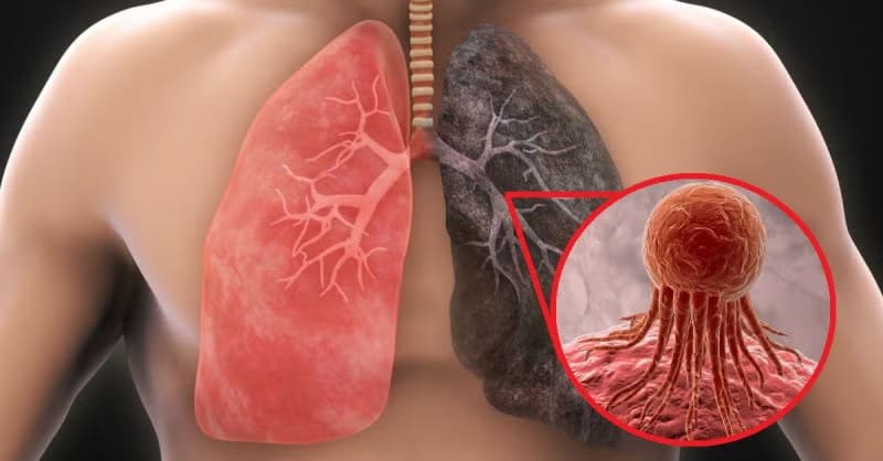 Cáncer de pulmón va en aumento, se presenta también en jóvenes