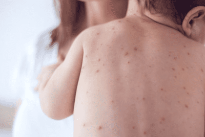 Emiten nueva alerta por sarampión