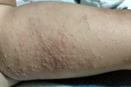 Hay alerta sanitaria por sarampión y dengue