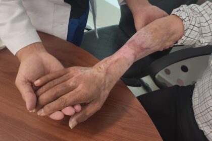 El brazo del adulto mayor, visiblemente recuperado