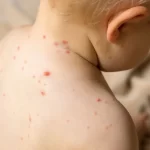 El Sistema Nacional de Vigilancia Epidemiológica lanzó un Aviso Epidemiológico