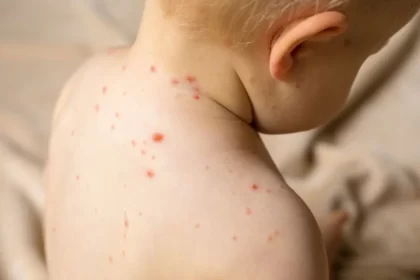 El Sistema Nacional de Vigilancia Epidemiológica lanzó un Aviso Epidemiológico