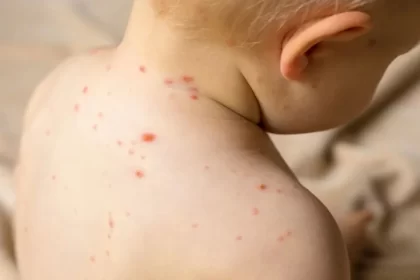 Aguascalientes es uno de los estados que se mantiene libre de la contagiosa enfermedad