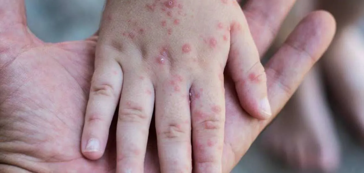 Primer caso sospechoso se presenta a dias de iniciar nuevo ciclo escolar