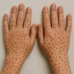 Brote activo de sarampión en Jalisco nos puede alcanzar