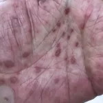 La gonorrea también está en su punto más alto