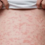 Activo el brote de sarampión en Jesús María