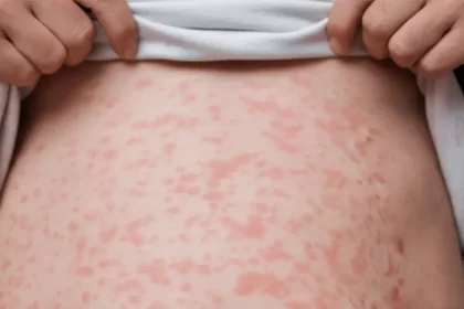 Activo el brote de sarampión en Jesús María