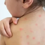 La menor contagiada de sarampión sigue en el hospital