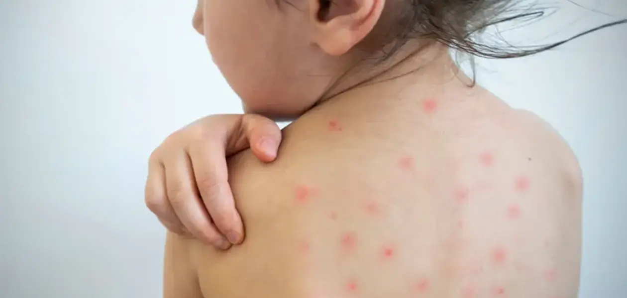 La menor contagiada de sarampión sigue en el hospital