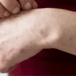 Quinto caso sarampión: mujer de 30 años