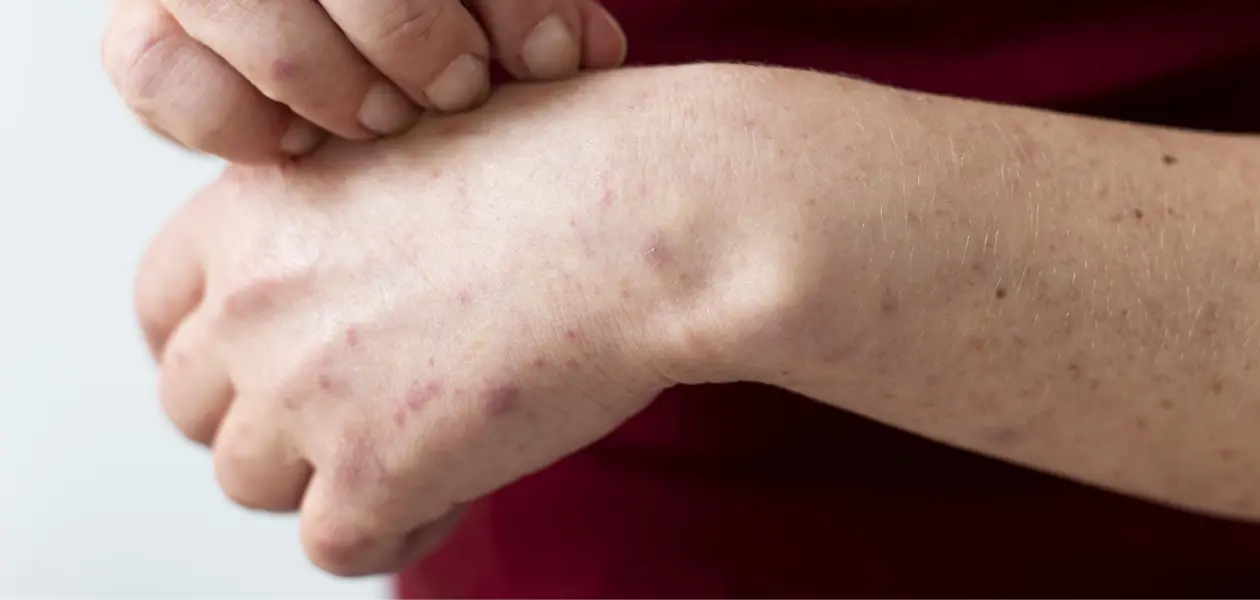 Quinto caso sarampión: mujer de 30 años