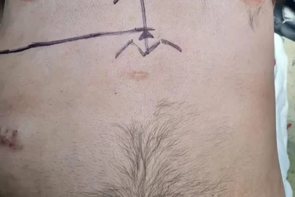 Retiran tumor gigantesco a joven en HGZ 3 del IMSS