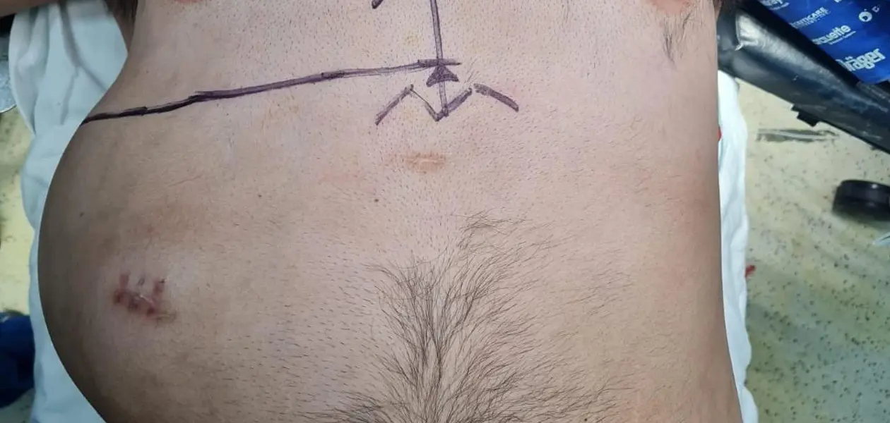 Retiran tumor gigantesco a joven en HGZ 3 del IMSS