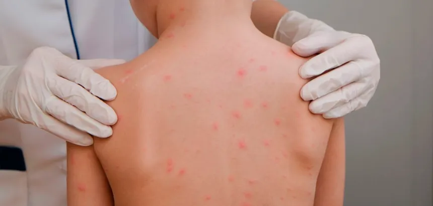 Cuarto caso de sarampión