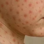 Brote de sarampión alcanza nivel epidémico