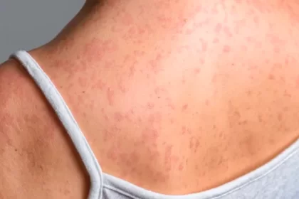 Brote de sarampión sigue amenazando a los aguascalentenses