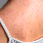 Confirman otros 3 casos de sarampión