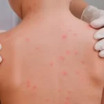 Son ya en Aguascalientes seis casos confirmados de sarampión, de acuerdo a con la Secretaría de Salud federal