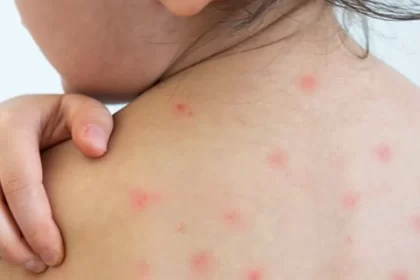 Ya son 8 casos de sarampión, pero se mantiene saldo blanco