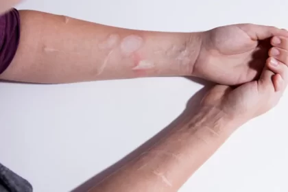 Autolesiones son problema delicado que puede escalar hasta el suicidio