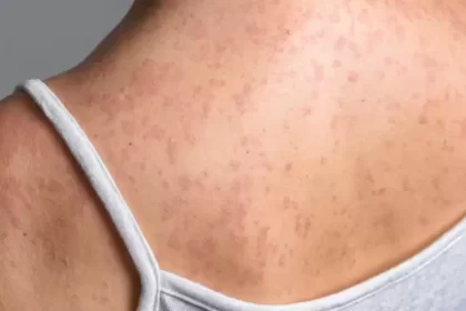 Sarampión causa secuelas delicadas, Seguro Social