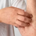 Suman ya 12 casos de sarampión en el Estado