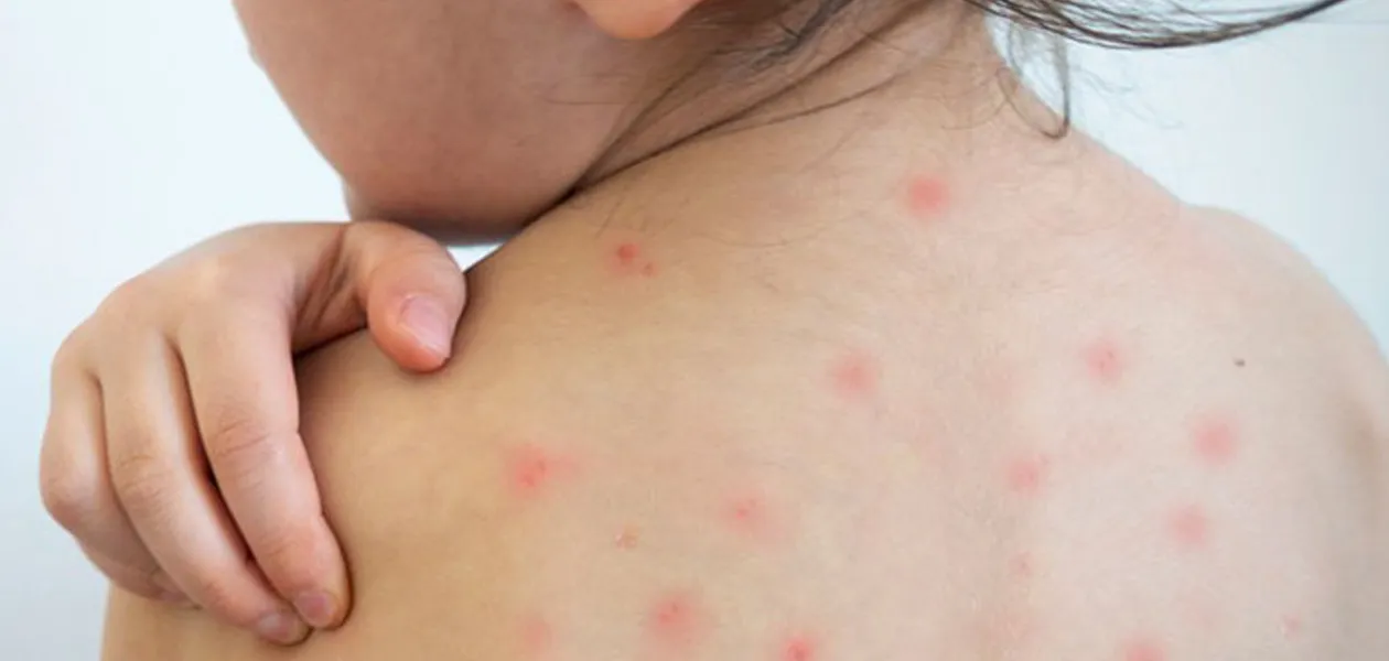 Clausura temporal de guardería y activan alerta por contagio de sarampión