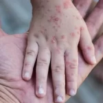 No paran los contagios de sarampión: suman ya 26 casos