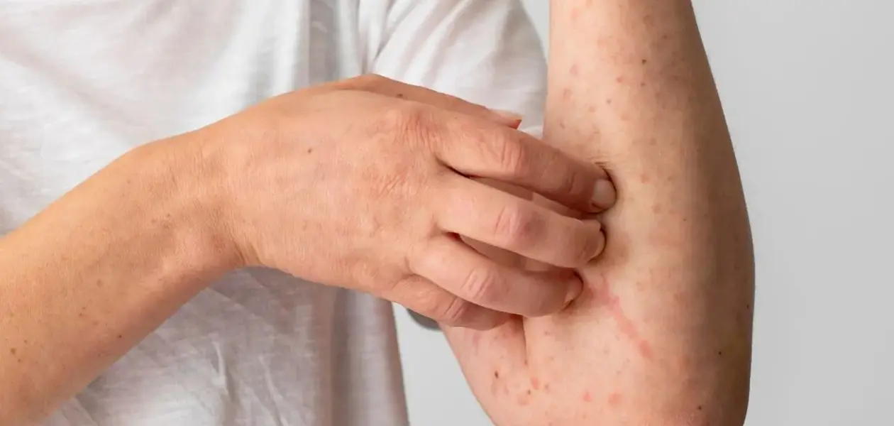 Tres casos más de sarampión, ya son 17