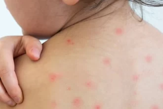 Reactivan la Alerta Sanitaria por nuevo caso de sarampión