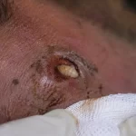 Libre Aguascalientes de humanos infectados con gusano barrenador