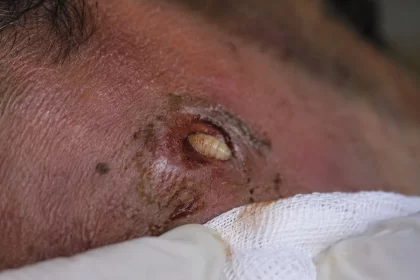 Libre Aguascalientes de humanos infectados con gusano barrenador