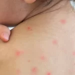 Reporta ISSEA dos casos más de dengue; suman ya 5 en el presente año
