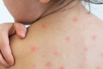 Reporta ISSEA dos casos más de dengue; suman ya 5 en el presente año