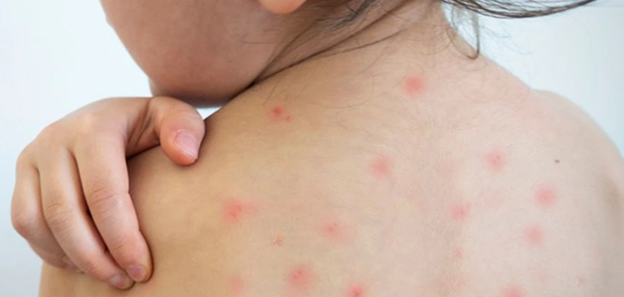 Reporta ISSEA dos casos más de dengue; suman ya 5 en el presente año