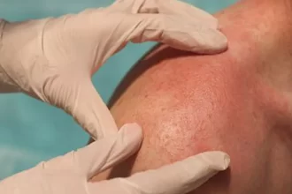 Intensidad solar en Aguascalientes: dermatólogos urgen a proteger la piel