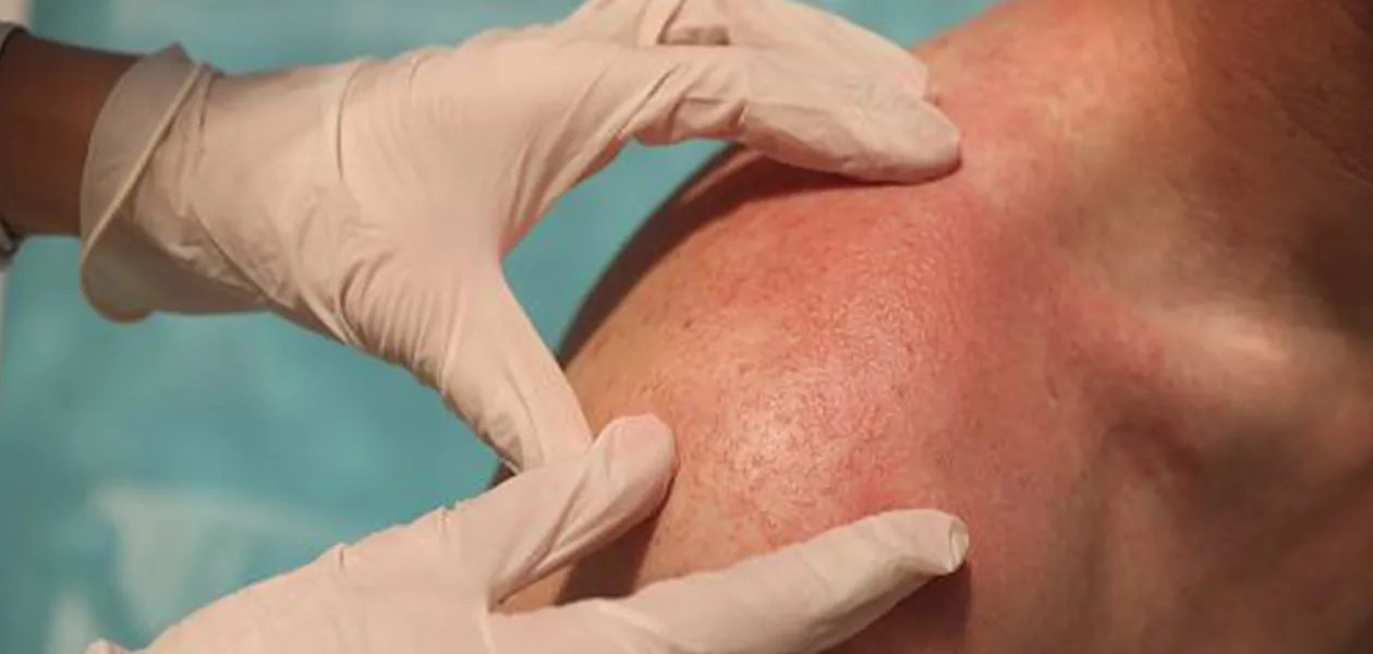 Intensidad solar en Aguascalientes: dermatólogos urgen a proteger la piel